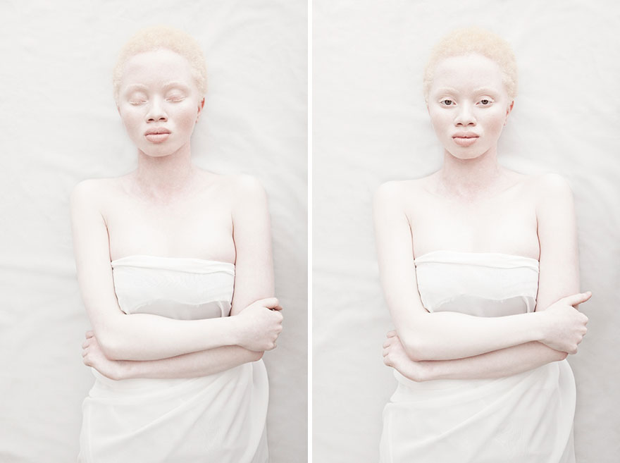 Также из-за сверхчувствительности кожи к свету солнца, среди альбиносов наблюдается повышенный риск развития злокачественных опухолей. 