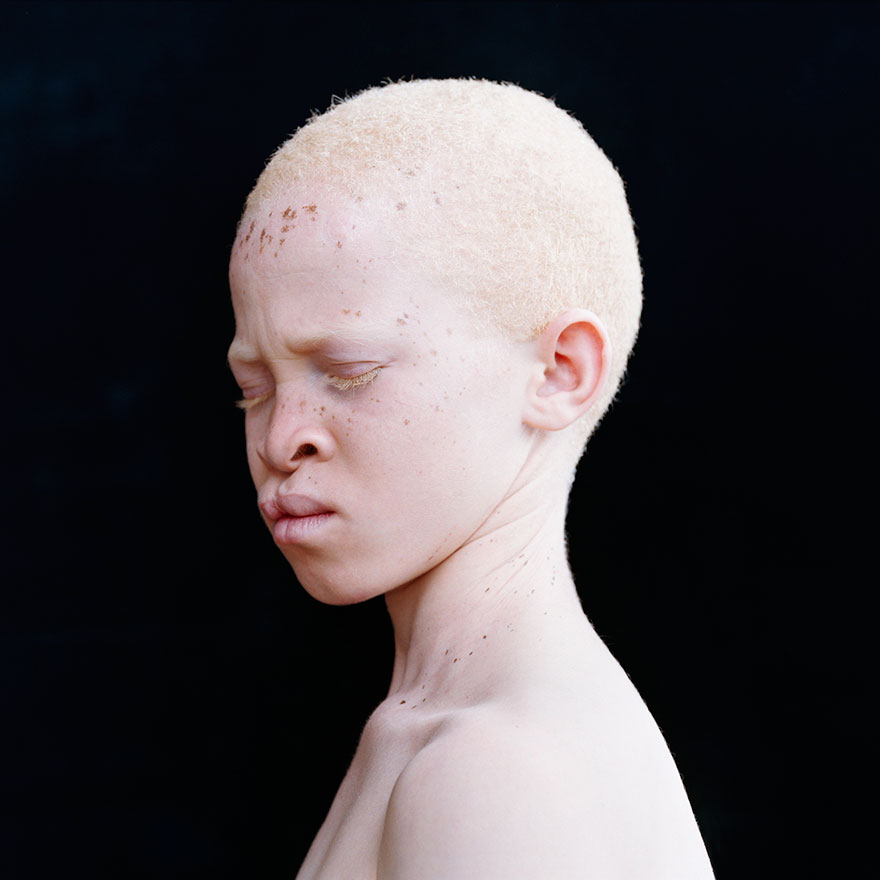 В цивилизациях с низким уровнем культуры и толерантности (а это почти полмира, если не больше) люди-альбиносы нередко становятся без вины виноватыми изгоями. 